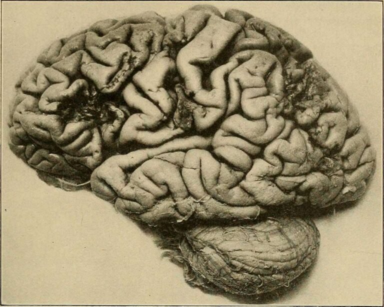 ¿Qué es el Alzheimer? Síntomas y Tipos de Demencia